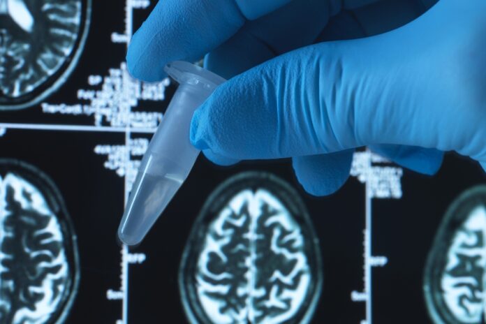 brasileiros-testam-potencial-remedio-de-baixo-custo-contra-alzheimer