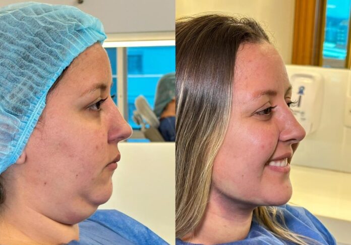 a-papada-nao-e-so-estetica:-entenda-as-causas-e-como-trata-la-com-seguranca-e-tecnica