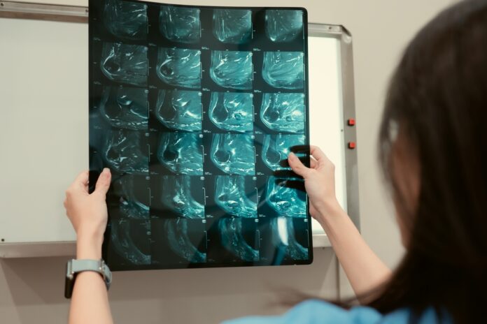 ia-consegue-prever-risco-de-cancer-de-mama-com-5-anos-de-antecedencia