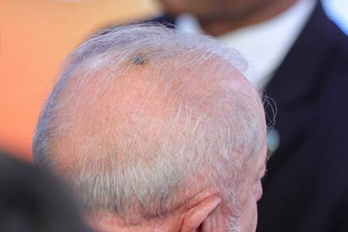 queratose:-dermatologistas-explicam-sinal-retirado-por-lula