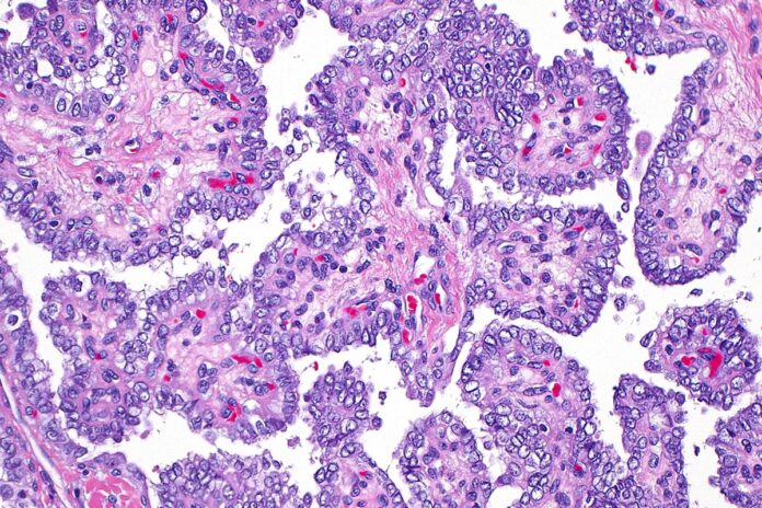 endocrinologista-lista-os-principais-sintomas-do-cancer-de-tireoide