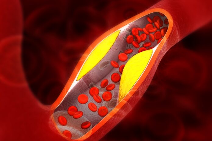 cardiologistas-explicam-os-principais-sintomas-de-gordura-nas-arterias