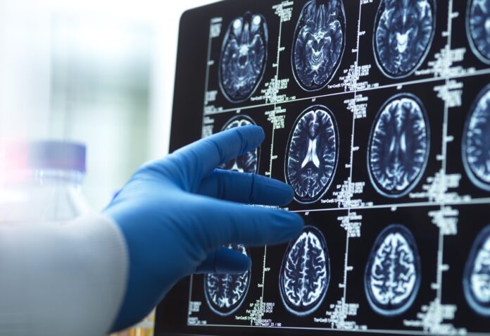 neurologista-explica-quais-sao-os-principais-sintomas-do-alzheimer