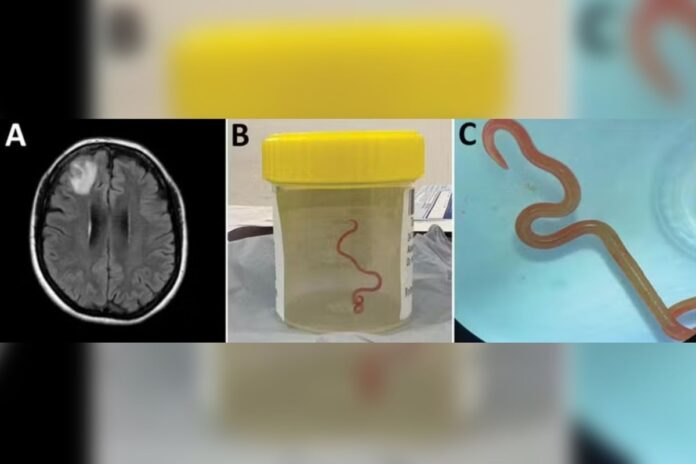 verme-parasita-de-cobra-e-encontrado-pela-1a-vez-no-cerebro-de-humanos