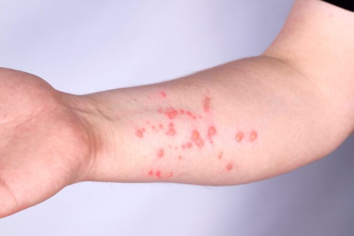 oms-alerta-sobre-nova-variante-da-mpox-e-falha-do-antiviral