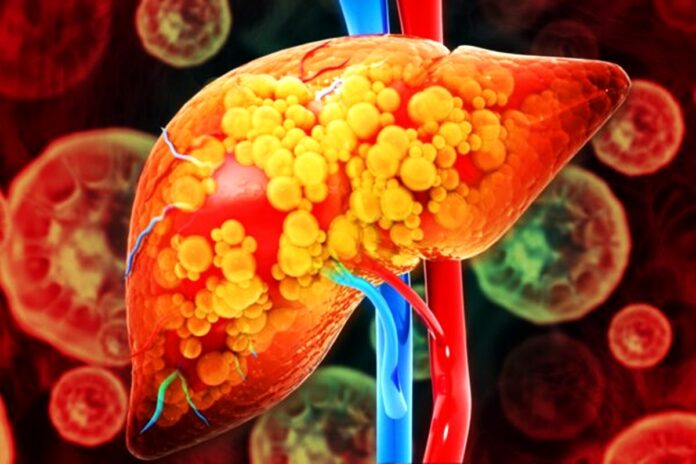hepatologistas-explicam-o-que-causa-gordura-no-figado