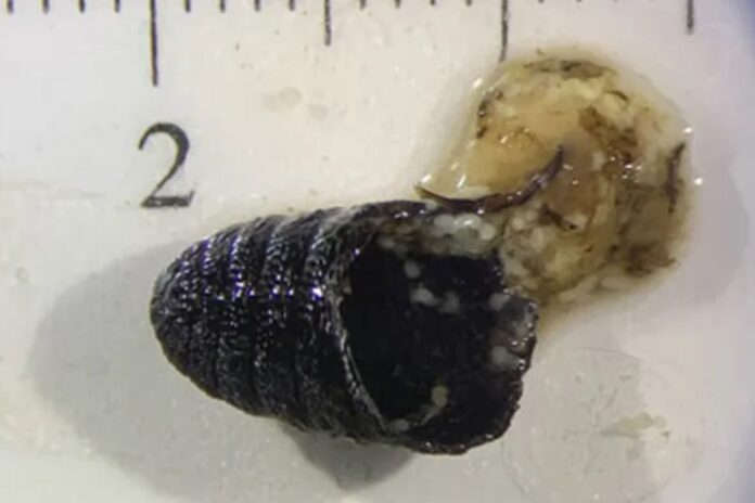 com-infeccao-rara,-mulher-espirra-larvas-e-pupa-de-mosca