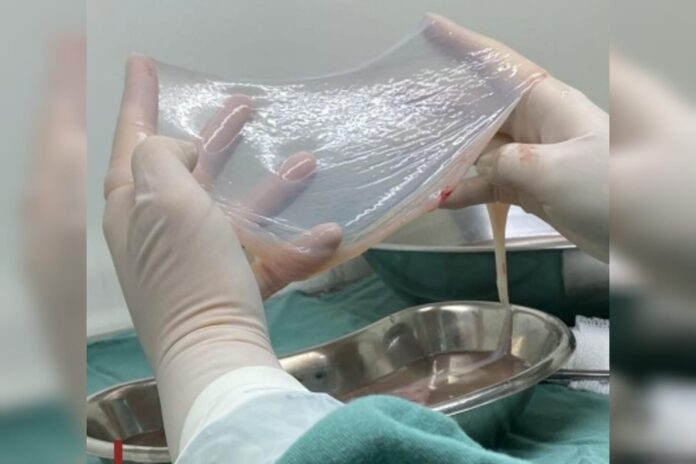 sus-amplia-uso-de-tecido-amniotico-para-tratar-pacientes-com-diabetes