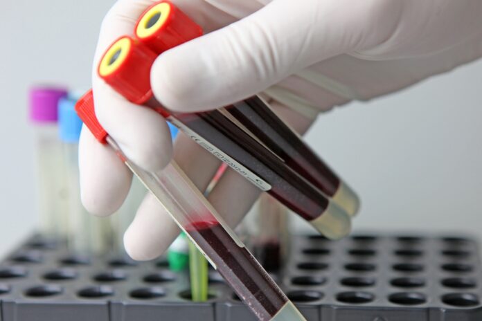 exame-de-sangue-pode-detectar-cicatrizes-no-figado-antes-do-cancer