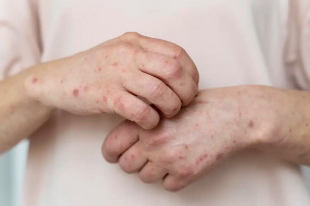 sintomas-variados-podem-atrasar-diagnostico-do-lupus