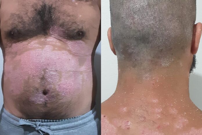 “achei-que-nao-teria-mais-vida-a-dois”,-diz-paciente-com-psoriase-grave