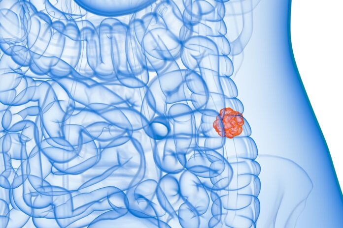 sus-adotara-exame-nao-invasivo-para-identificar-cancer-de-intestino