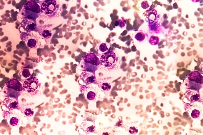 mieloma-multiplo-pode-exigir-ate-10-consultas-ate-ser-descoberto