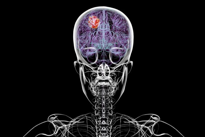 pesquisa-associa-alguns-contraceptivos-a-maior-risco-de-tumor-cerebral