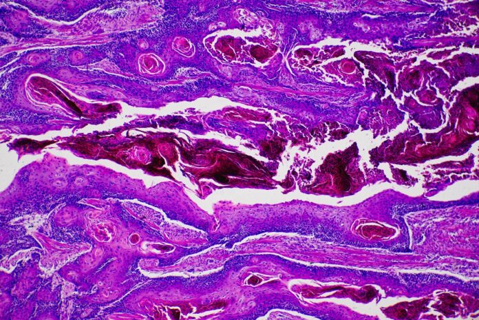 oms-alerta-que-novos-casos-de-cancer-podem-quase-duplicar-ate-2050