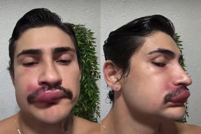 triangulo-da-morte:-espremer-espinha-no-rosto-pode-causar-infeccao
