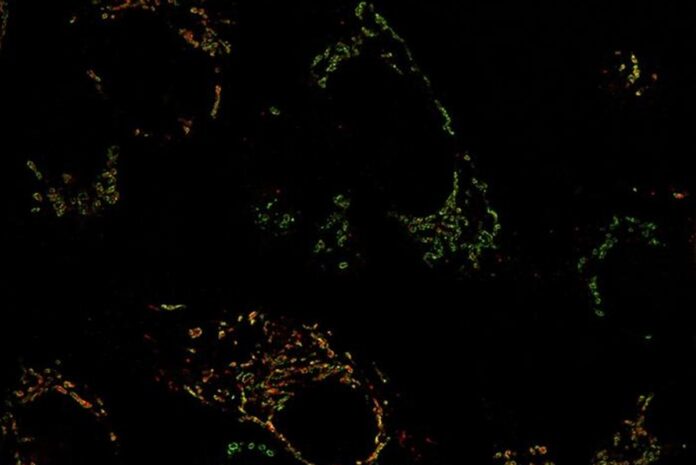 vulnerabilidade-pode-virar-alvo-em-cancer-de-mama-agressivo,-mostra-estudo